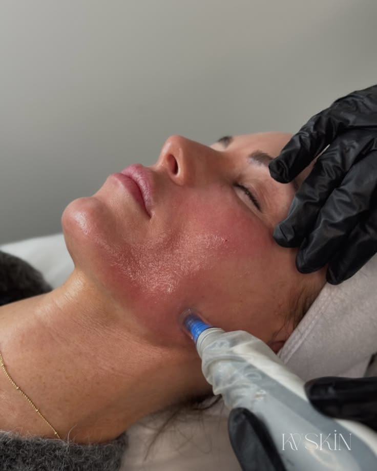 جلسة الديرمابن (Dermapen / Microneedling) - صورة 2