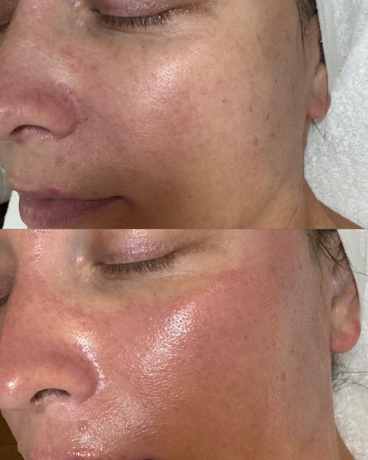 جلسة الديرمابن (Dermapen / Microneedling) - صورة 3