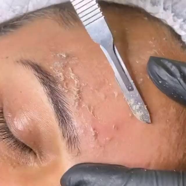 جلسة الديرما بلانينج (Dermaplaning) - صورة 2