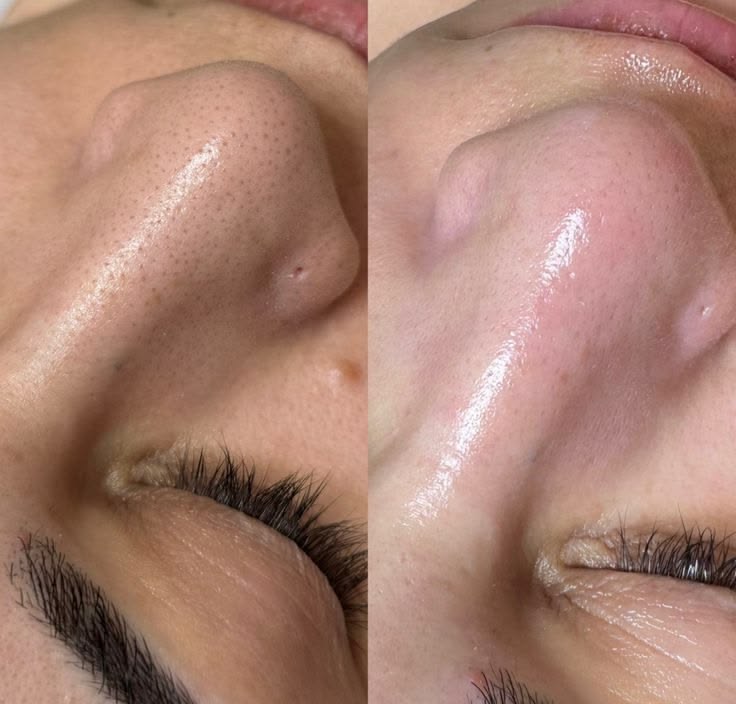 جلسة الهيدرافيشل (Hydrafacial) - صورة 1