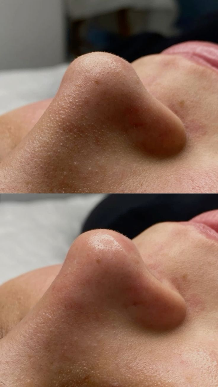 جلسة تنظيف البشرة السوفت (Soft Facial) - صورة 1